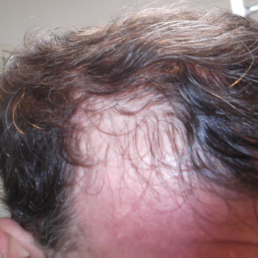 alopecia-areata-29