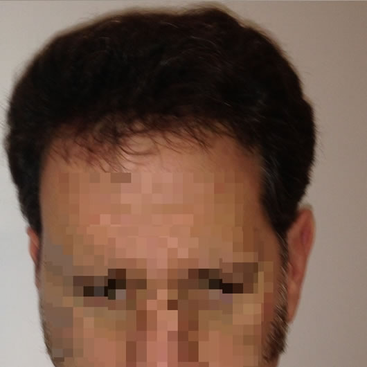 alopecia-areata-30