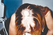 alopecia-areata-01 alopecia-areata-01