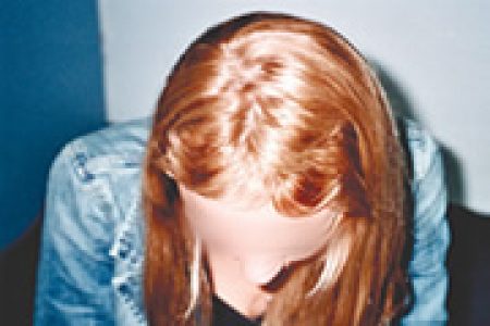 alopecia-areata-02 alopecia-areata-02