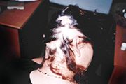 alopecia-areata-03 alopecia-areata-03