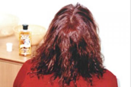 alopecia-areata-04 alopecia-areata-04