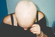 alopecia-areata-05 alopecia-areata-05