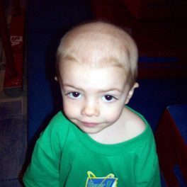 alopecia-areata-13 alopecia-areata-13