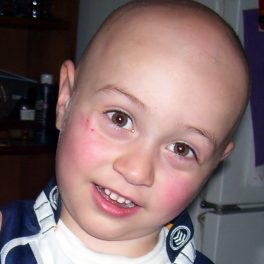 alopecia-areata-15 alopecia-areata-15