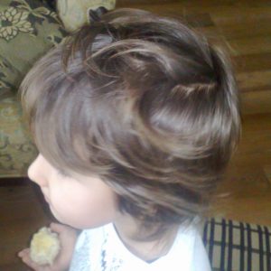 alopecia-areata-17 alopecia-areata-17