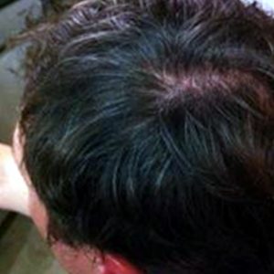 alopecia-areata-21 alopecia-areata-21