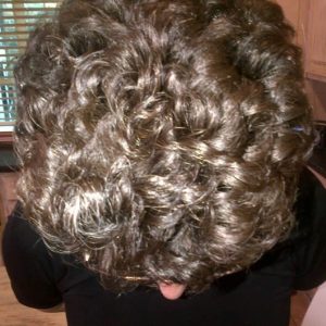 alopecia-areata-26 alopecia-areata-26