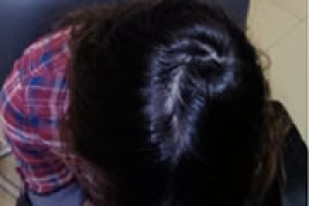 alopecia-areata-28 alopecia-areata-28
