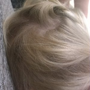 alopecia-areata-32 alopecia-areata-32