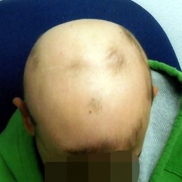 alopecia-areata-51 alopecia-areata-51
