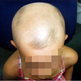 alopecia-areata-53 alopecia-areata-53