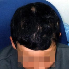 alopecia-areata-56 alopecia-areata-56