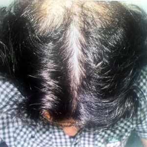 alopecia-areata-57 alopecia-areata-57