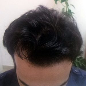 alopecia-areata-58 alopecia-areata-58