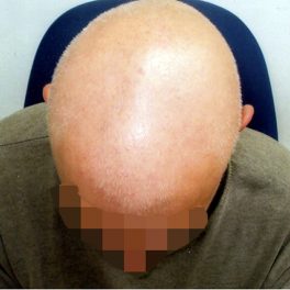 alopecia-areata-59 alopecia-areata-59