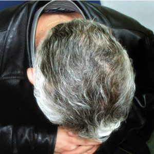 alopecia-areata-60 alopecia-areata-60