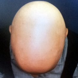 alopecia-areata-61 alopecia-areata-61