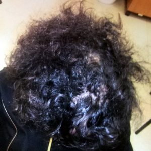 alopecia-areata-62 alopecia-areata-62