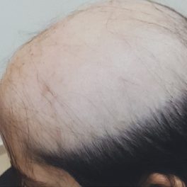 alopecia-areata-63 alopecia-areata-63