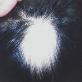 alopecia-areata-65 alopecia-areata-65